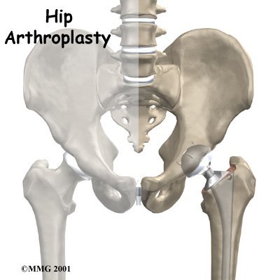 Artificial Joint Replacement of the Hip