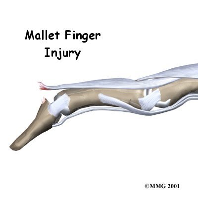 Mallet Finger Injuries
