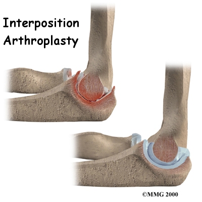 Interposition Arthroplasty