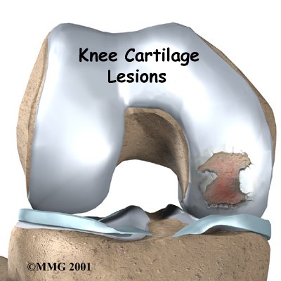 Articular Cartilage Problems of the Knee